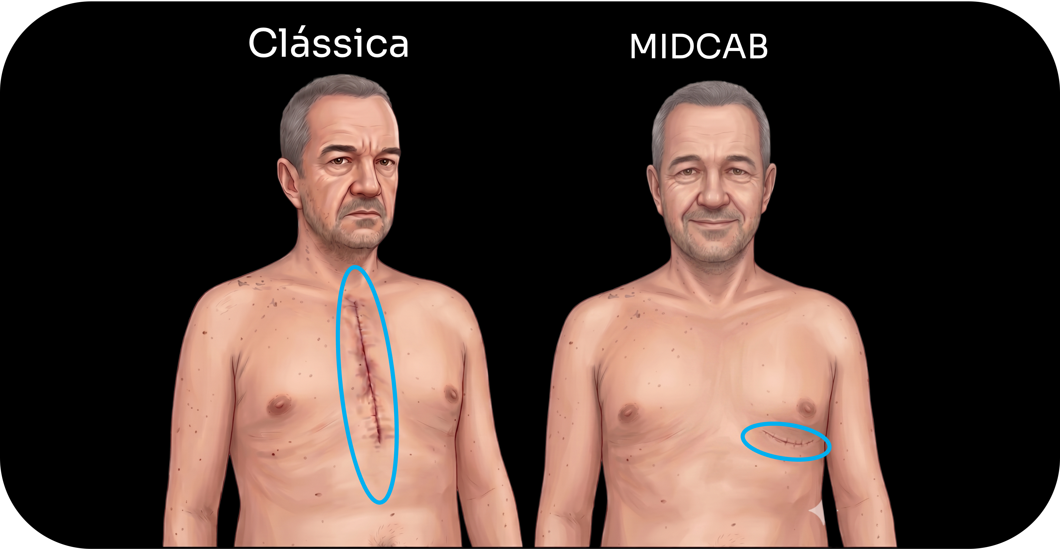 cicatrizes de acesso cirúrgico para revascularização do miocárdio por via clássica e por via minimamente invasiva