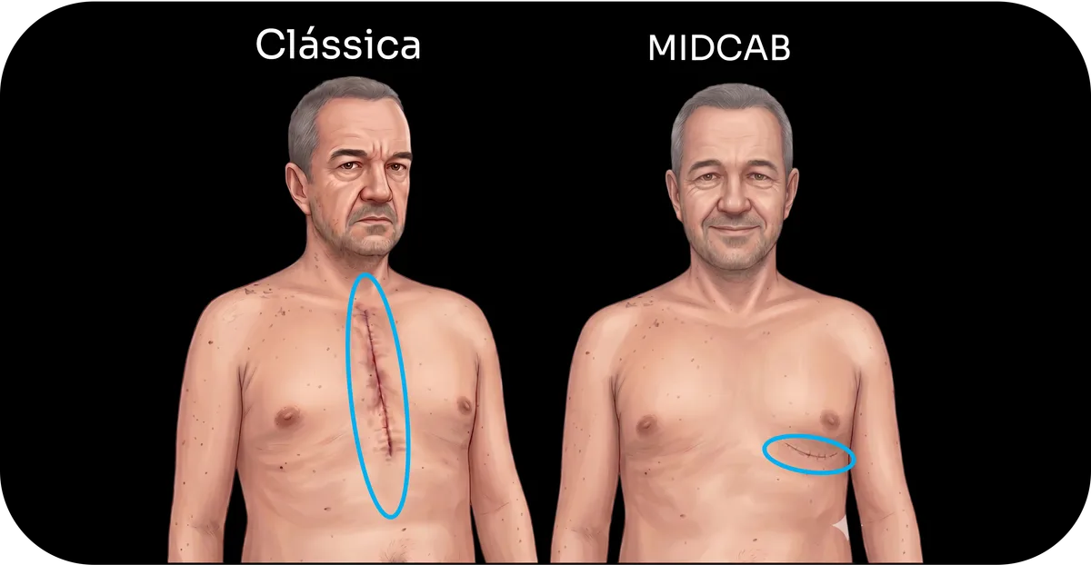 cicatrizes de acesso cirúrgico para revascularização do miocárdio por via clássica e por via minimamente invasiva
