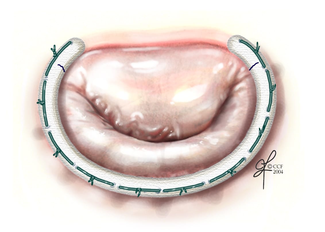 mitral-ring