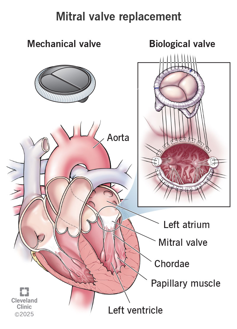 mitral-valve-replacement-mechanical-and-biological-prosthesis