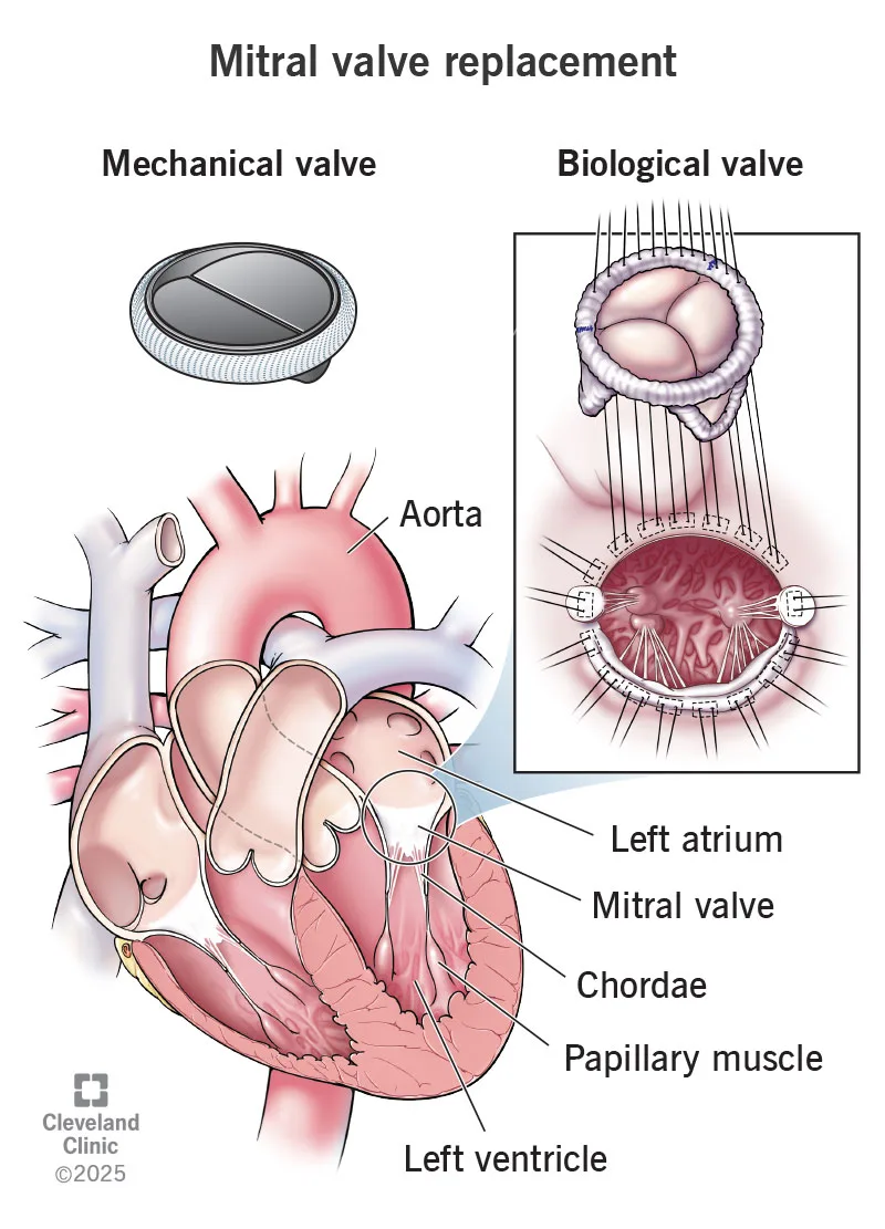 mitral-valve-replacement-mechanical-and-biological-prosthesis