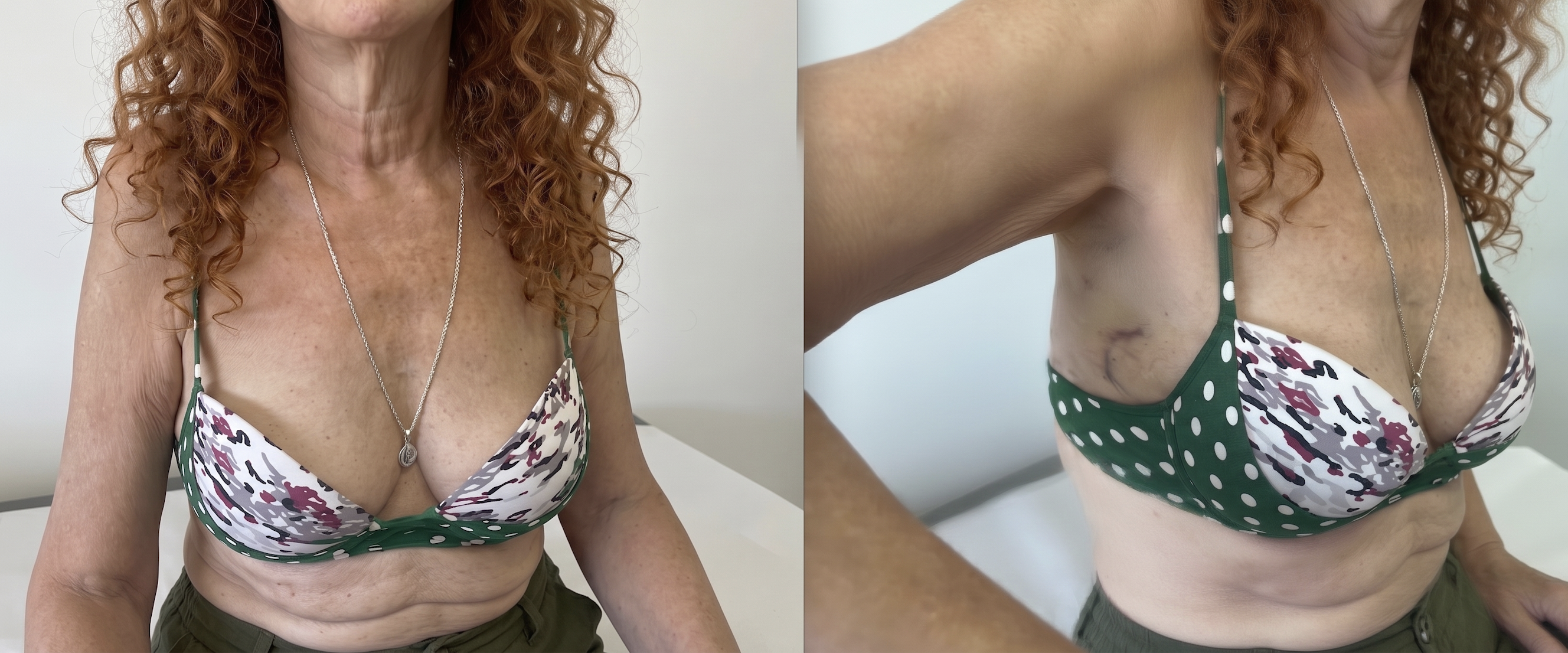 female-miami-method-invisible-scar-for-valve-surgery