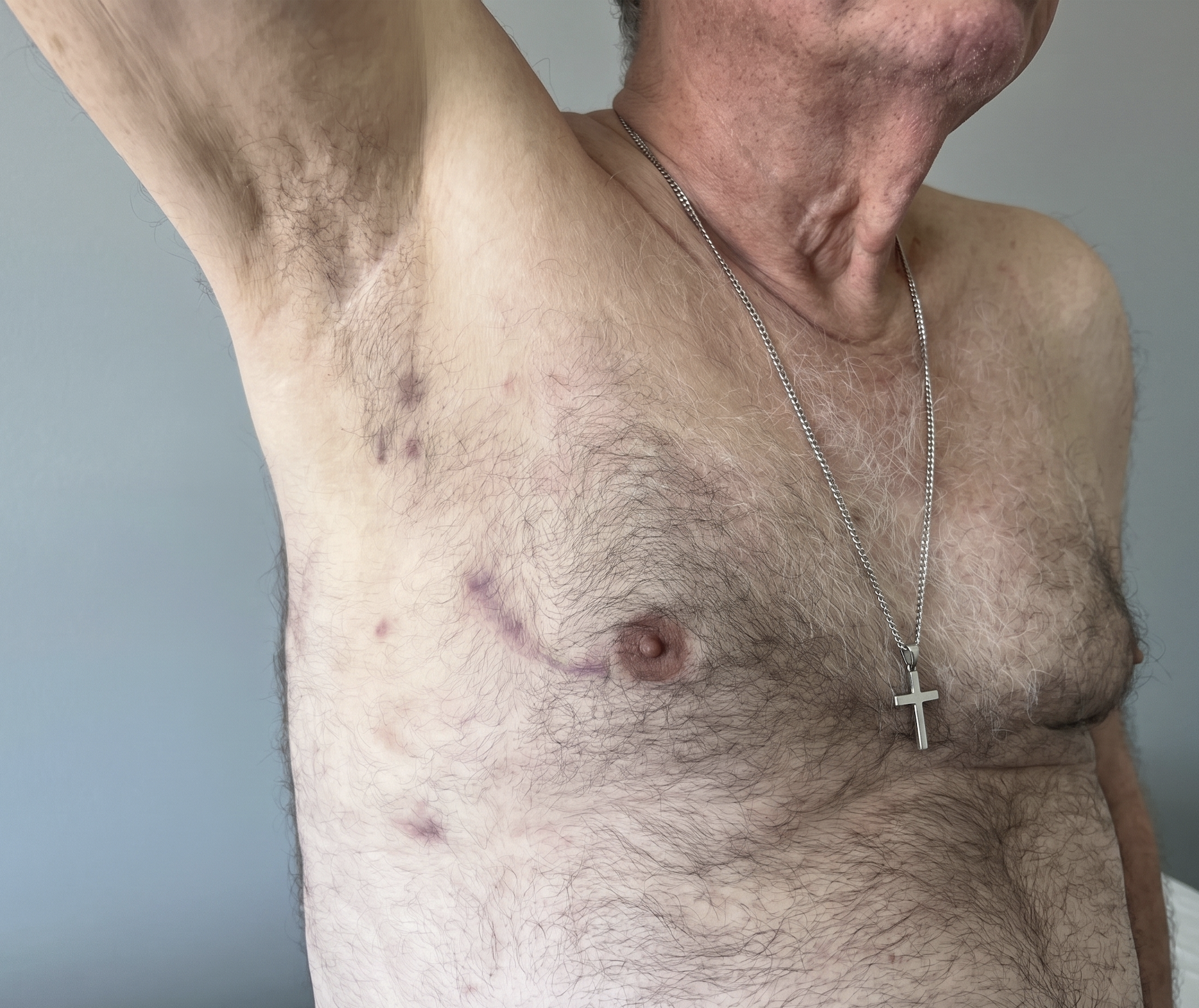 male-miami-method-incision-for-valve-surgery