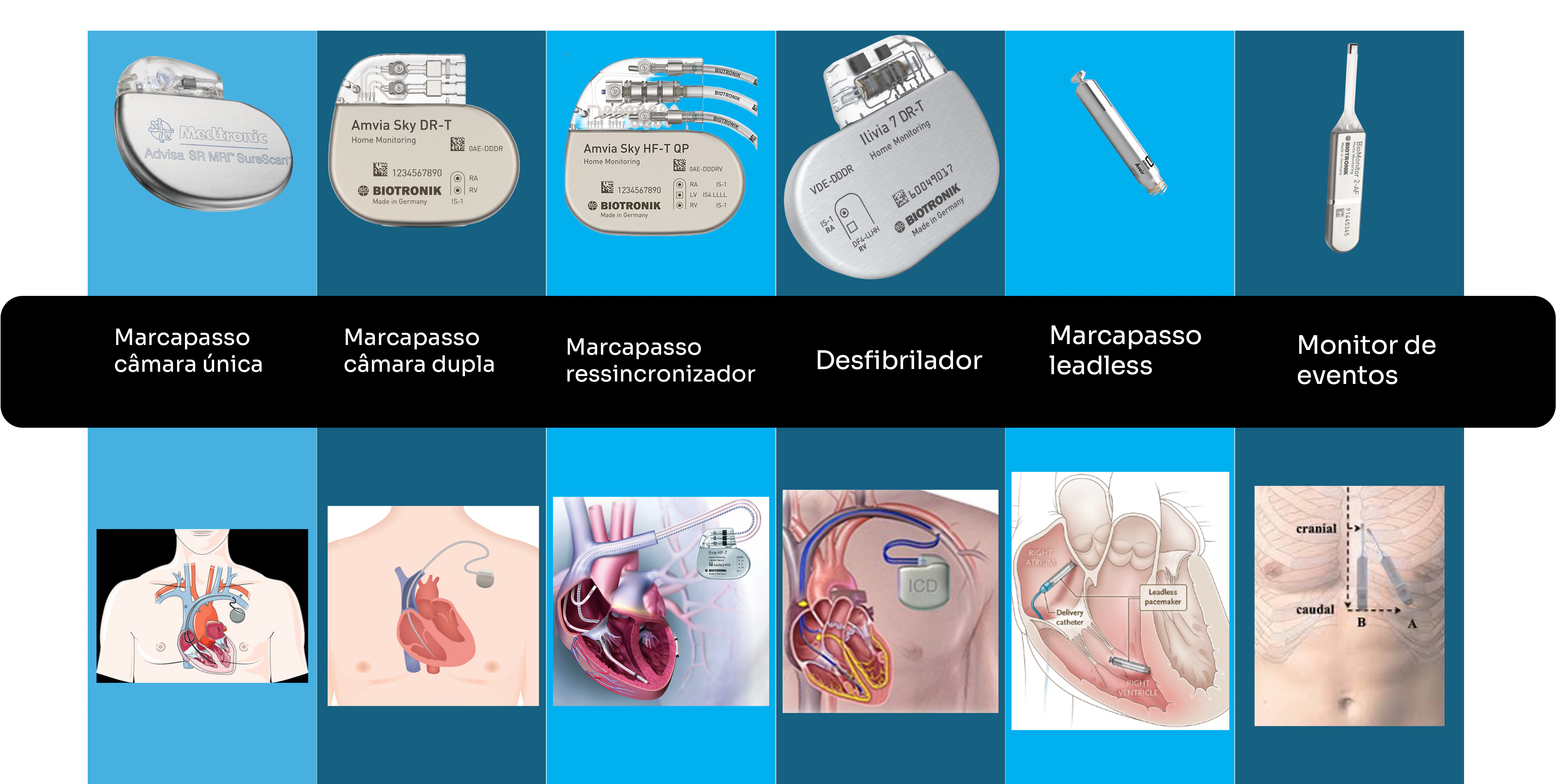 Tabela com os diversos tipos de dispositivos eletrônicos cardíacos: marcapasso, desfibrilador, marcapasso leadless, monitor de eventos